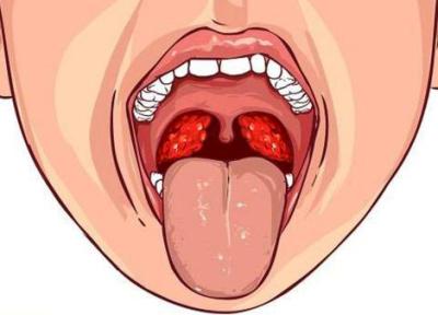 سرطان دهان چه نشانه هایی دارد؟